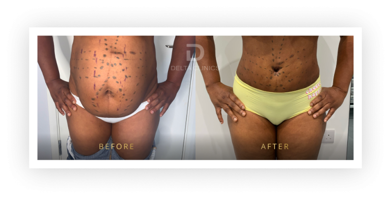 6 Months Post Operation. Tummy tuck with waistline high definition, liposuction with VASER, skin tightening and muscle repair.