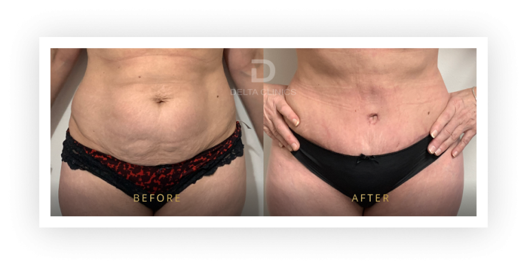 6 Months Post Operation. Tummy tuck with waistline high definition, liposuction with VASER, skin tightening and muscle repair.