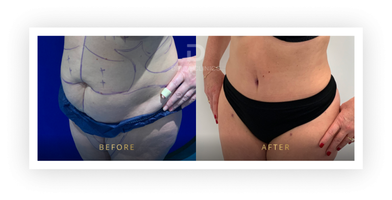6 Months Post Operation. Tummy tuck with waistline high definition, liposuction with VASER, skin tightening and muscle repair.