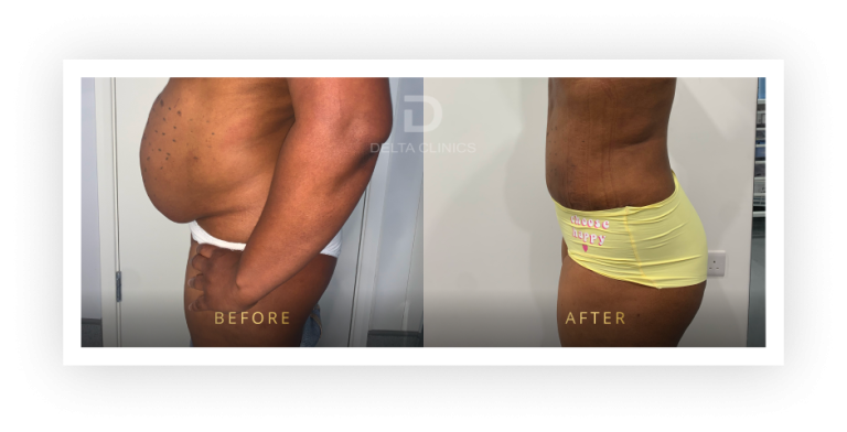 6 Months Post Operation. Tummy tuck with waistline high definition, liposuction with VASER, skin tightening and muscle repair.