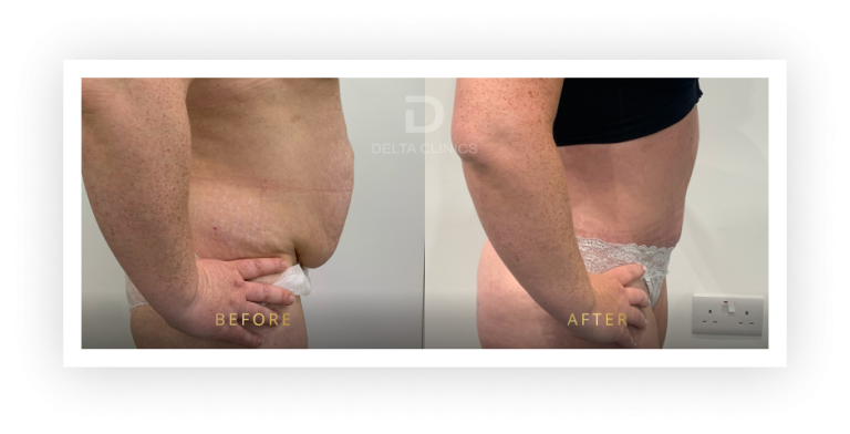 6 Months Post Operation. Tummy tuck with waistline high definition, liposuction with VASER, skin tightening and muscle repair.