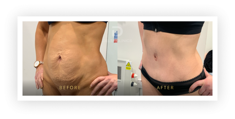 6 Months Post Operation. Tummy tuck with waistline high definition, liposuction with VASER, skin tightening and muscle repair.
