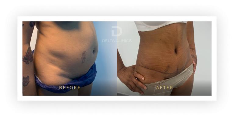 6 Months Post Operation. Tummy tuck with waistline high definition, liposuction with VASER, skin tightening and muscle repair.