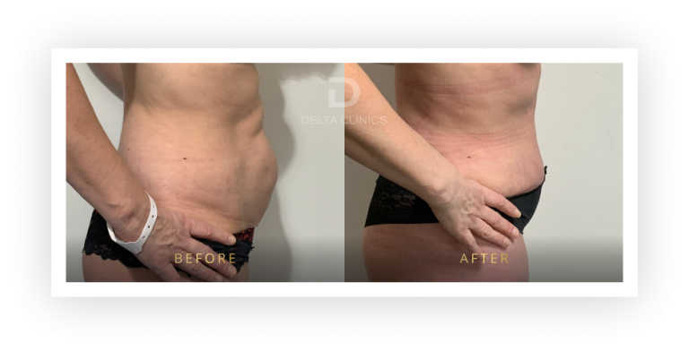 6 Months Post Operation. Tummy tuck with waistline high definition, liposuction with VASER, skin tightening and muscle repair.