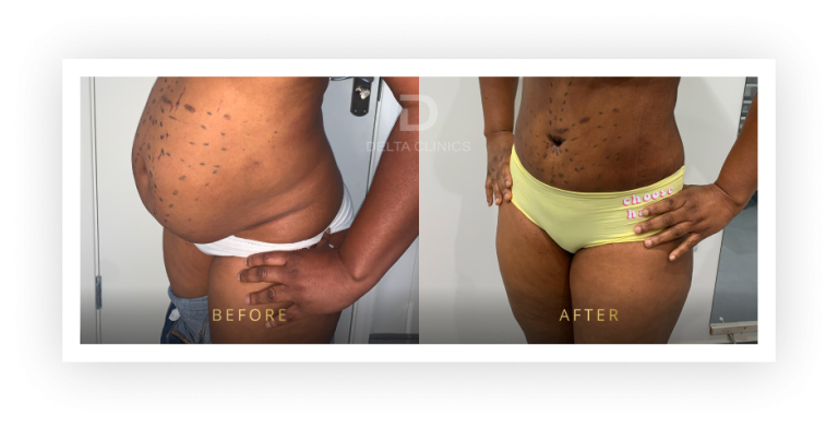 6 Months Post Operation. Tummy tuck with waistline high definition, liposuction with VASER, skin tightening and muscle repair.