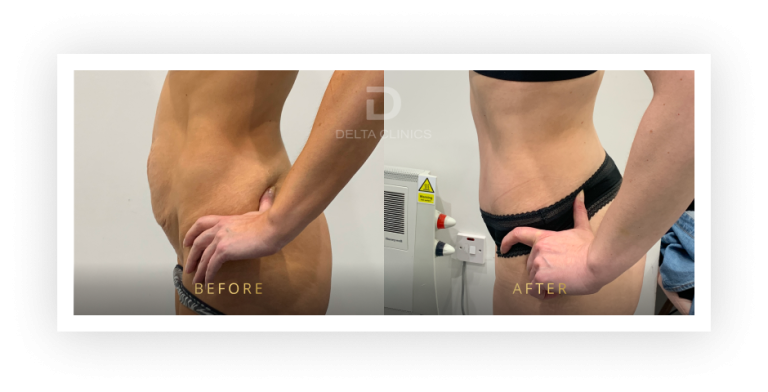 6 Months Post Operation. Tummy tuck with waistline high definition, liposuction with VASER, skin tightening and muscle repair.