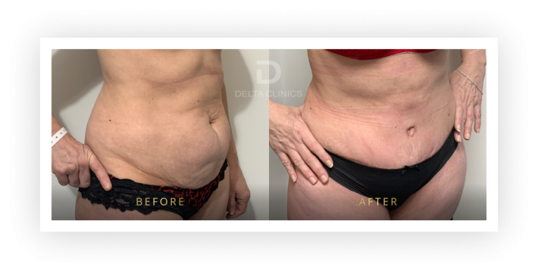 6 Months Post Operation. Tummy tuck with waistline high definition, liposuction with VASER, skin tightening and muscle repair.