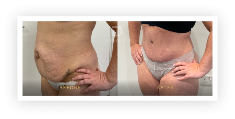 6 Months Post Operation. Tummy tuck with waistline high definition, liposuction with VASER, skin tightening and muscle repair.