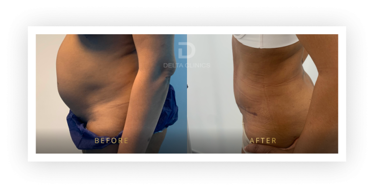 6 Months Post Operation. Tummy tuck with waistline high definition, liposuction with VASER, skin tightening and muscle repair.