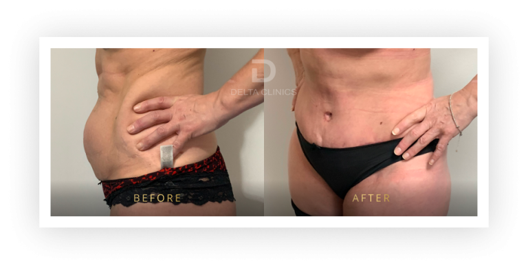 6 Months Post Operation. Tummy tuck with waistline high definition, liposuction with VASER, skin tightening and muscle repair.