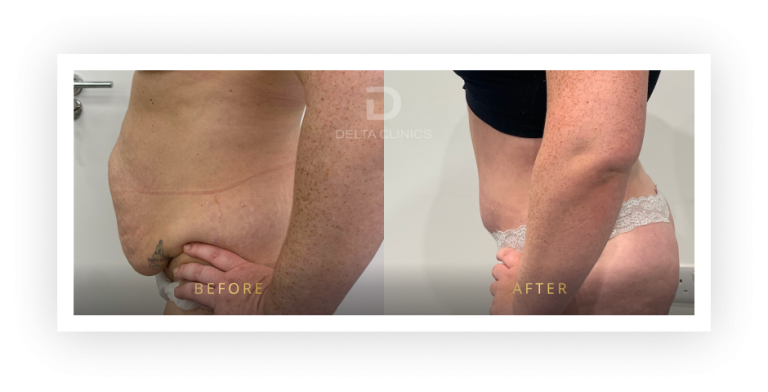 6 Months Post Operation. Tummy tuck with waistline high definition, liposuction with VASER, skin tightening and muscle repair.