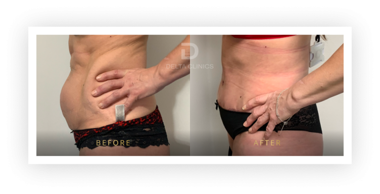 6 Months Post Operation. Tummy tuck with waistline high definition, liposuction with VASER, skin tightening and muscle repair.